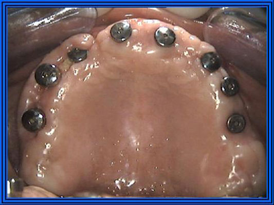implantologia dentale Marco Parravoni