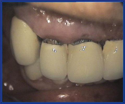 implantologia dentale Marco Parravoni
