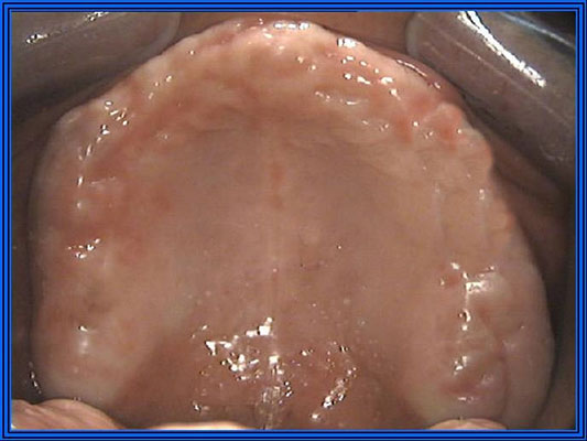 implantologia dentale Marco Parravoni