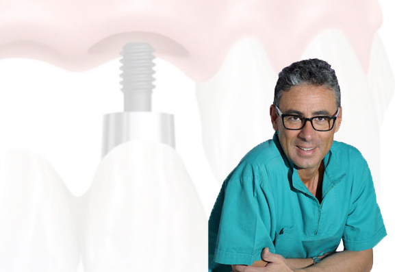 Marco-Parravano-implantologia-Abruzzo