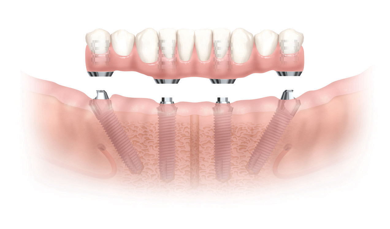 implantologia dentale Marco Parravoni